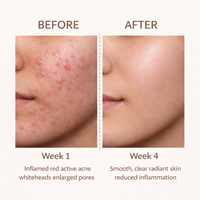 ClearCTRL Anti-Acne Face Serum